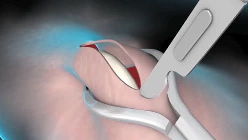 3d演示男性结扎手术的过程,看着都很疼!男网友:看完胯下有点凉