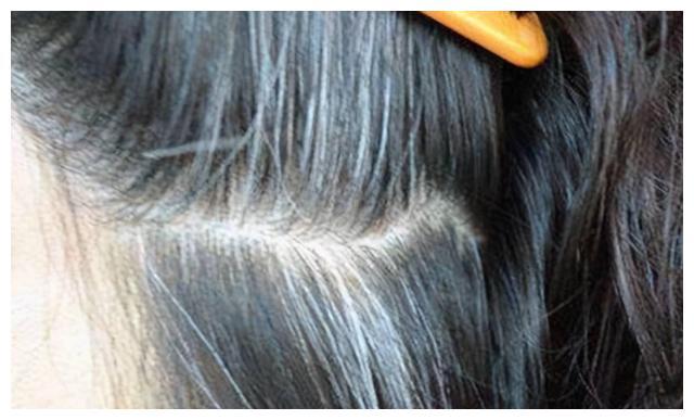 白发分别长在前额,两鬓,后脑勺,是什么情况?可能不是衰老导致