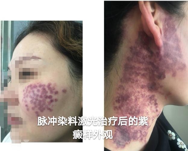 红色胎记要尽早治疗二鲜红斑痣
