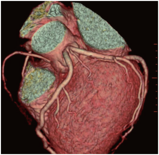 3.左前降支和左回旋支的单独起源