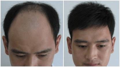 长年脱发导致谢顶!经常性脱发就看这个方法.