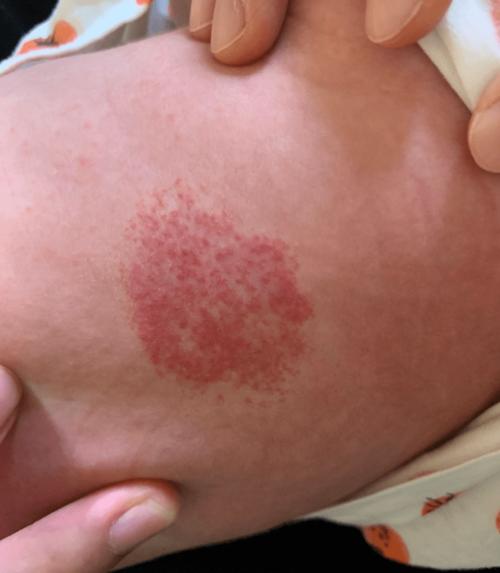 徐州市儿童医院介入专家李炯:早发现,早干预,血管瘤早期治疗手段简单