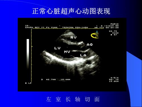 m型超声心动图ppt