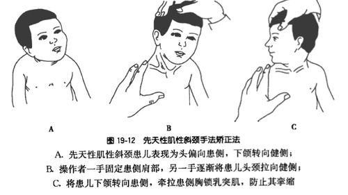 小儿斜颈的分型与诊治