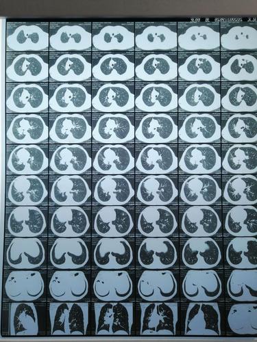 男性,吸烟多年,反复咳嗽,查胸部ct左肺占位,查气管镜确诊鳞癌