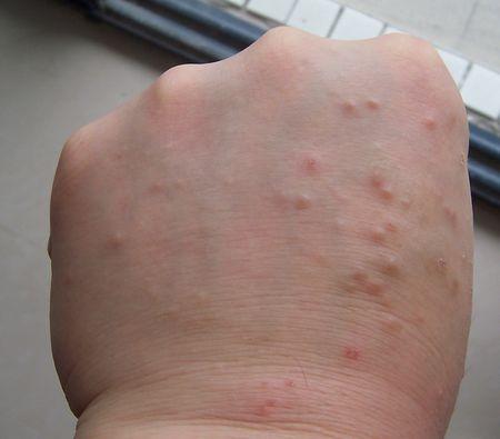 不是疥疮,硫磺膏无效,指缝,阴囊皆无此症状.