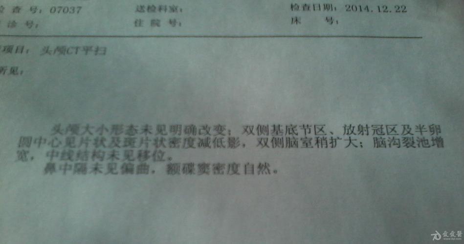 [病例讨论] 应该考虑脑萎缩吗