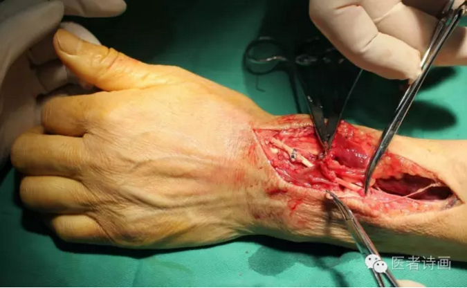 拇长伸肌腱自发断裂的手术修复方法