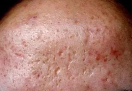 和炎性丘疹为主, 青春期内分泌失调,饮食和作息不规律就会长这种痘痘