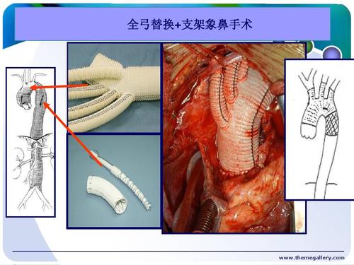 临床医学 主动脉夹层的诊断及治疗ppt 全弓替换 支架象鼻手术 http