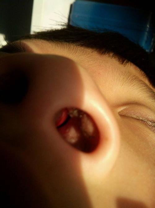 我儿子鼻子经常不透气,鼻子里面鼻夹很红很