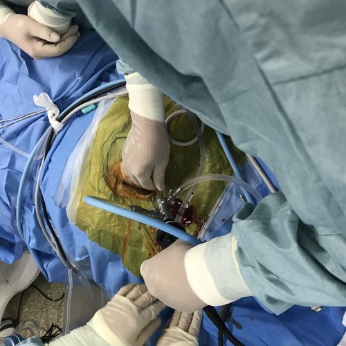 坐骨结节囊肿关节镜下切除术