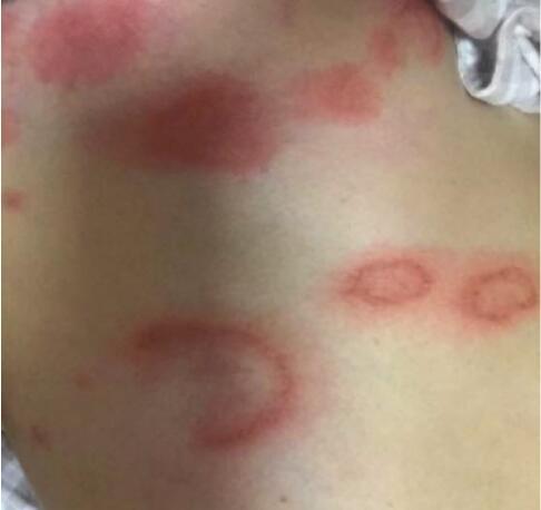 金钱癣又叫钱币状皮炎,又称"铜钱癣", "环癣","笔管癣","荷叶癣"