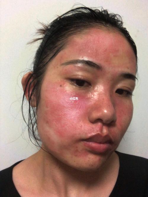 激素脸吗?_过敏_激素脸