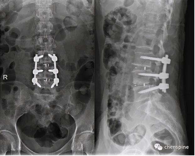腰椎x线片: 腰椎术后,l3/4-l4/5行腰椎减压植骨融合内固定术