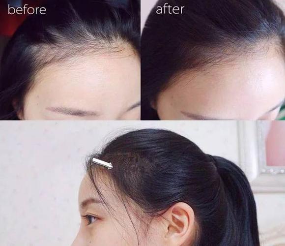 所长用到 第9,10天的时候,就发现头发分缝处,额头发际线,都长出了很多