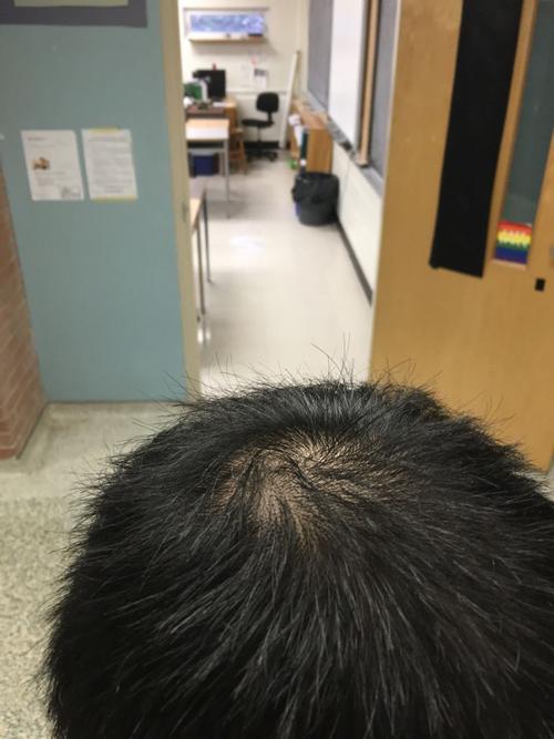 头旋周围头发稀少 最近同学说我是不是秃顶了 我今年才16岁 怎样做