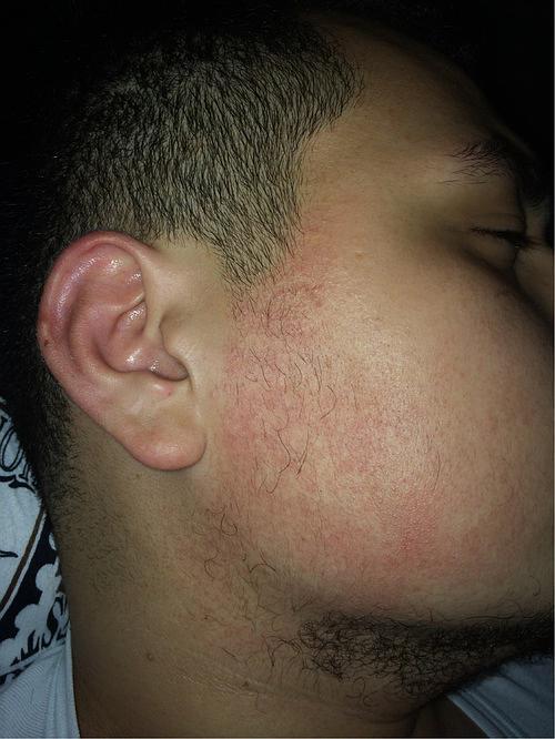 脸上的鸡皮肤和过敏性皮肤的我～秀图