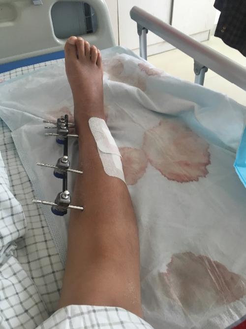 10出车祸,小腿骨折,做了一个星期牵引后准备做