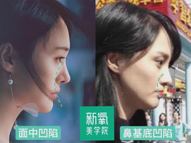 由于亚洲人的骨骼特征,大部分人都存在一定程度的鼻基底凹陷和面中