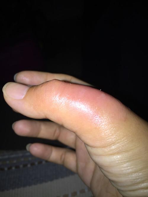 大拇指的第二节肿是怎么回事,是腱鞘炎吗?