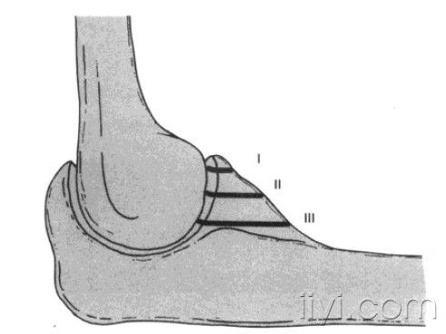 尺骨冠状突骨折,比较少见!  regan-morrey将其分为三型.