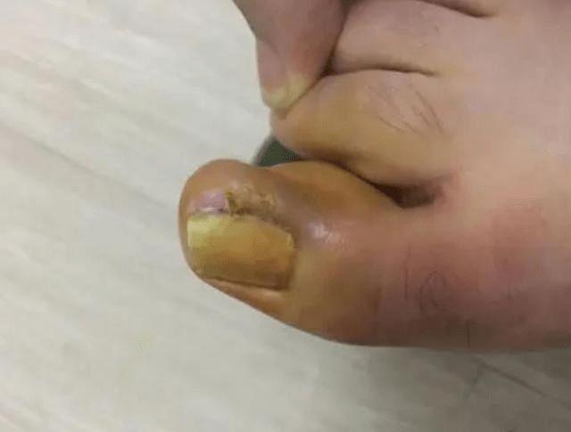 脚趾甲总往肉里"钻",一碰还疼?这些小妙招,或能告别甲沟炎