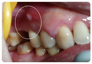 首页 牙周治疗 根尖周炎     病症介绍    症状