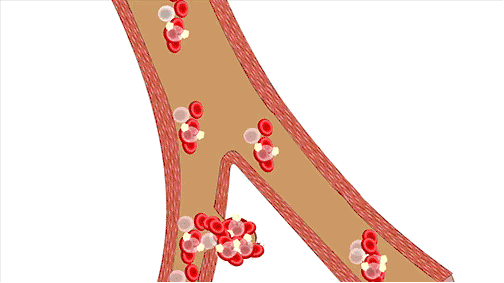 高血压等原因导致血管破裂