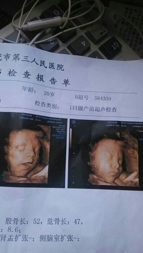 胎儿四维彩超图片 羊水穿刺图片 b超看胎儿性别图解 20周胎儿四维彩超