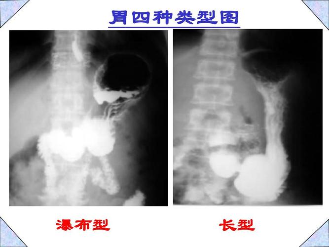 胃四种类型图 瀑布型 长型