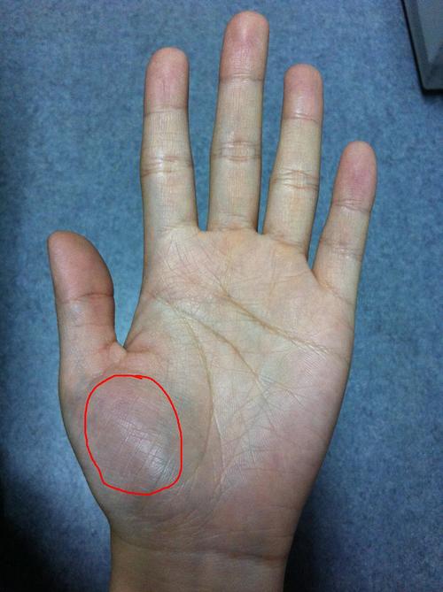 手的红圈部位突然很疼,大拇指不能用力.是怎么回事?谢谢