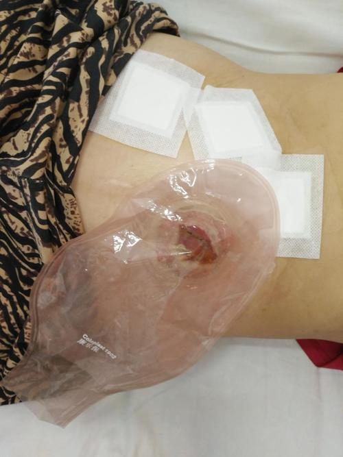 成功为直肠癌晚期t4bn2am1a患者在腹腔镜下行姑息性乙状结肠造瘘术