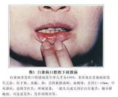 反复口腔溃疡,当心白塞病!白塞病有这4个症状