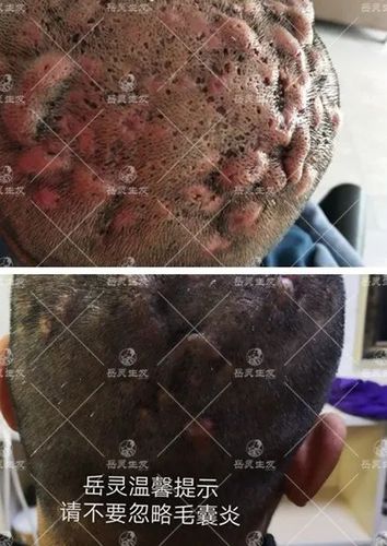 得了毛囊炎怎么办