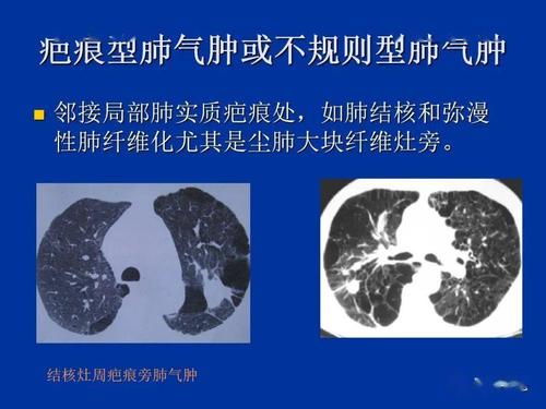 肺气肿的ct表现