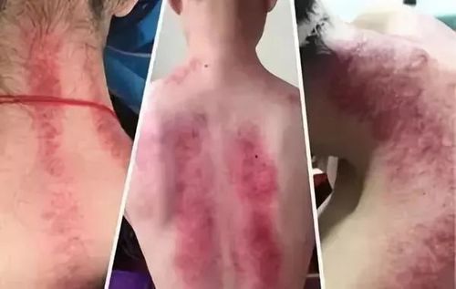 易经|痧症|刮痧