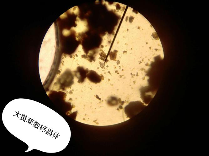 大黄草酸钙晶体