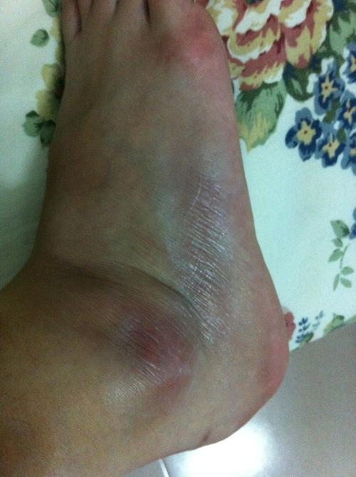 脚边上的皮肤硬化,是什么皮肤病?