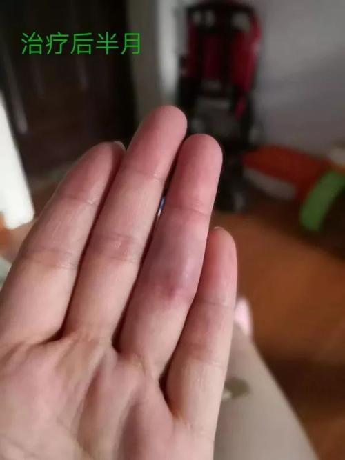 黄医生介绍,像小林这样的手部血管瘤患者较为常见, 主要分为