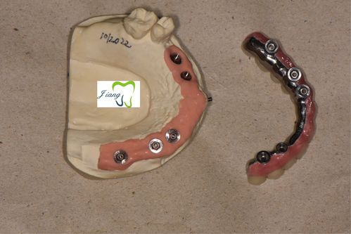 种植牙之纯钛多功能桥架 全瓷修复半口种植牙一例