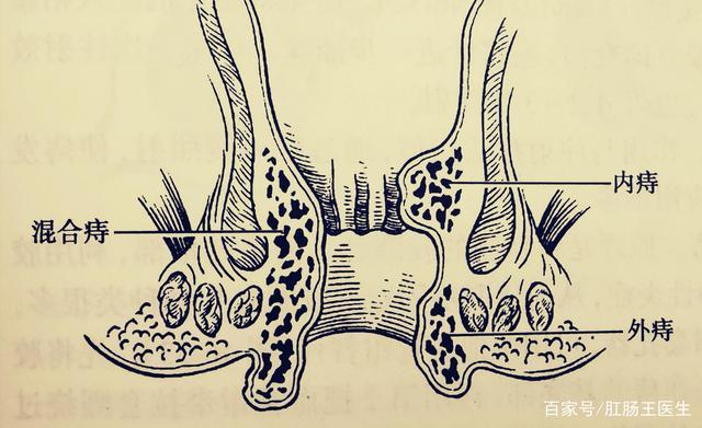同时得了肛瘘和痔疮该如何治疗?医生告诉您要这样选择