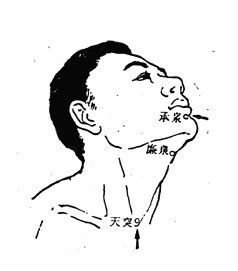 梅核气