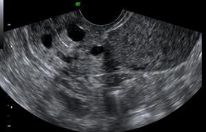 使粘液潴留,腺体扩大成囊状,形成子宫颈囊肿,又称子宫颈囊肿