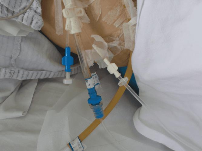 腹腔双套管冲洗及维护