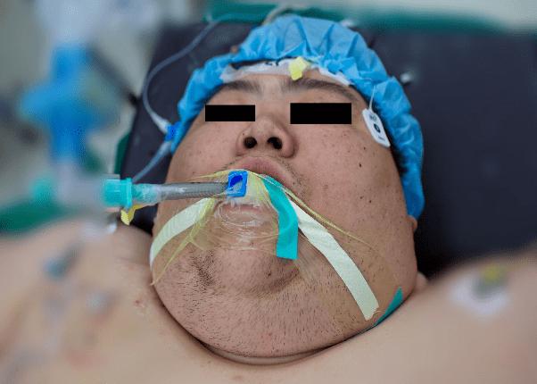 减重手术麻醉管理_插管