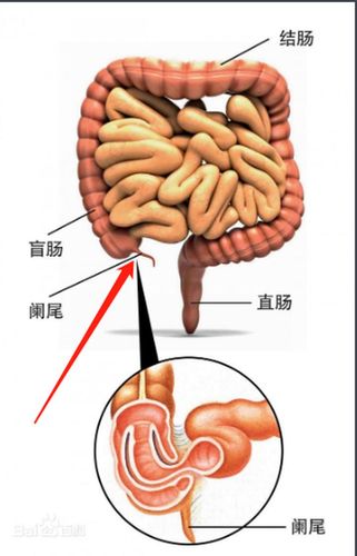 怎么区分是肚疼还是阑尾炎疼