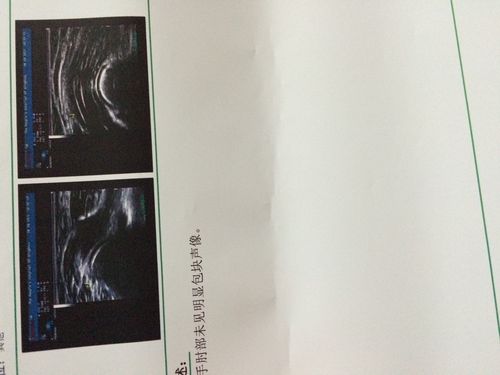 手肘上长了个硬硬的东西按着不疼但手肘内侧按压疼照了彩超说没什