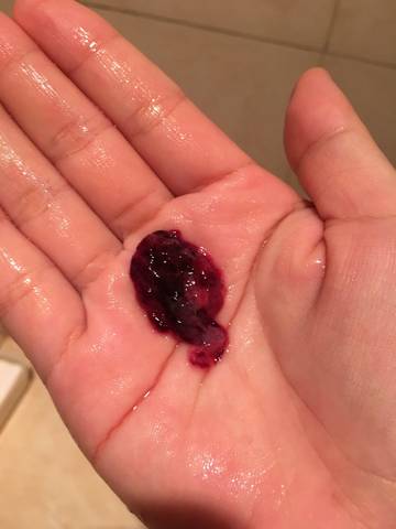 生化妊娠的排出物是这种吗?有图慎入