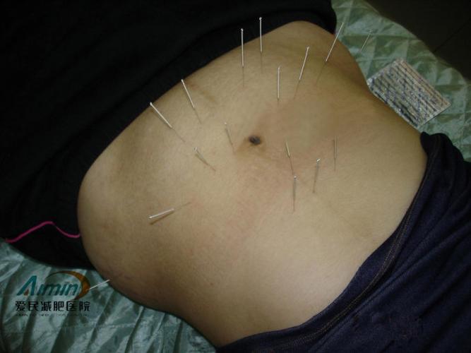 [转载]冬天进行针灸减肥有效吗?